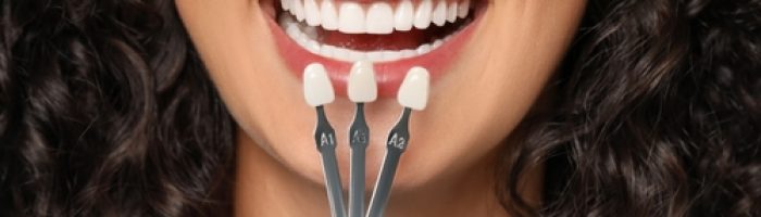 Doctor,Checking,Young,Woman's,Teeth,Color,,Closeup.,Dental,Veneers