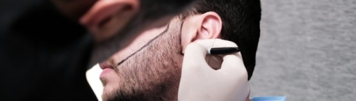 The,Doctor,Is,Planning,And,Marking,The,Patient's,Beard,Line